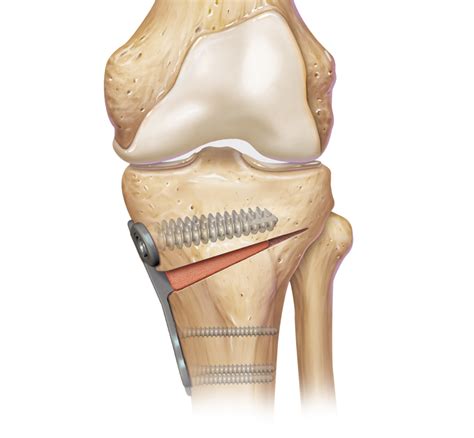 Arthrex - Tibial Opening Wedge