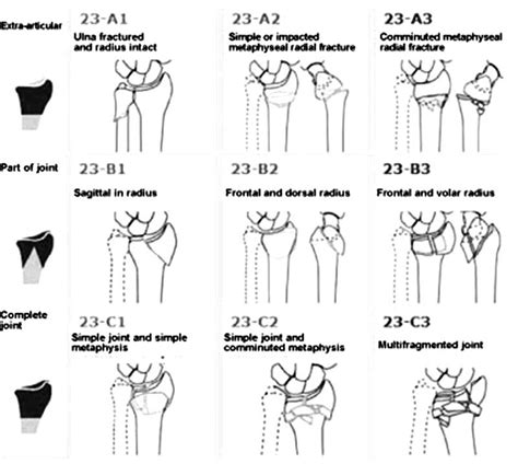 Colles Fracture Classification