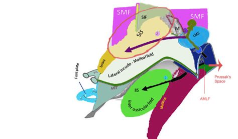 Figure showing the routes of spread of attic cholesteatoma from... | Download Scientific Diagram