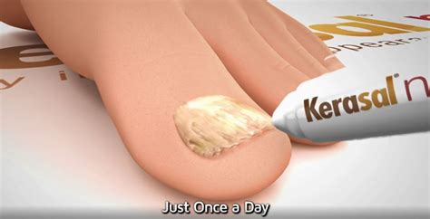 Kerasal Review - Visible Results In Just 1 Week! | Nail Care Hub