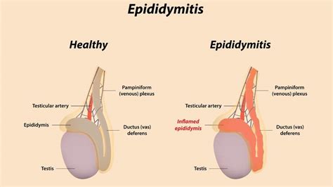 Stop sinus infection without antibiotics