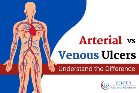 Arterial Vs. Venous Ulcers - Understand The Difference