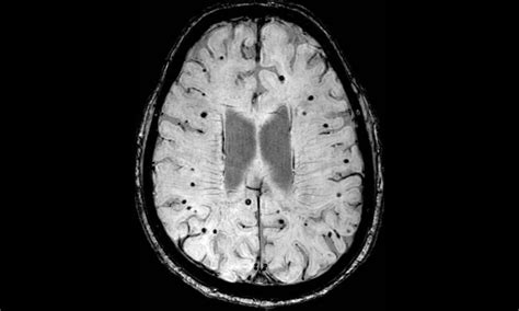 Could MRI scans be used to reduce risk of stroke patients suffering deadly brain bleeds? | UCL ...