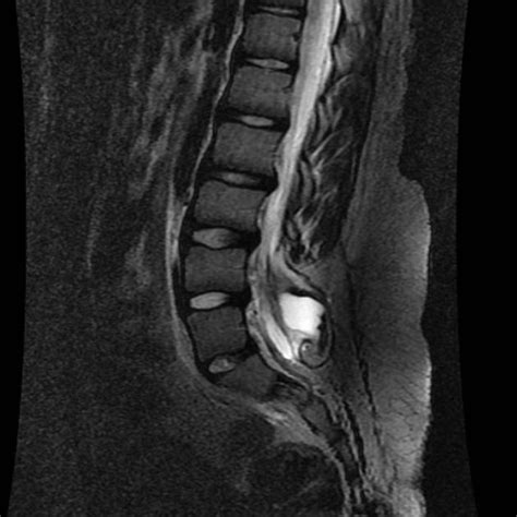 Spina Bifida Mri