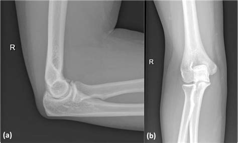 Olecranon Fossa X Ray