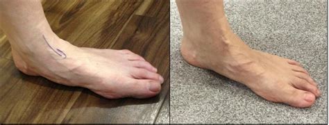 Flat Foot Surgery