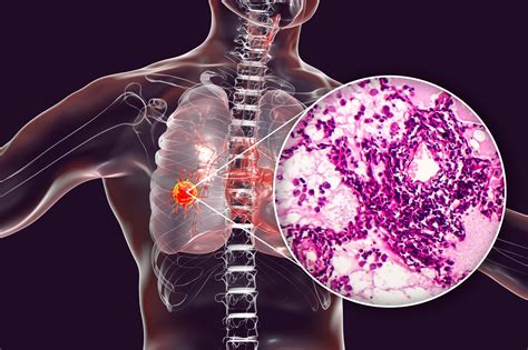 Proteomic map of human lung adenocarcinoma revealed