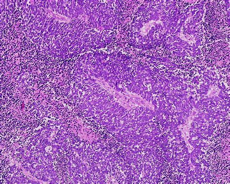 Small cell carcinoma of the lung laboratory tests - wikidoc