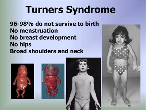 What Do You Know About Turner Syndrome - vrogue.co