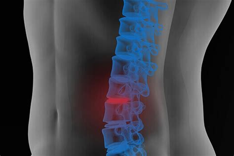 Lumbar Spine Cysts: Causes and Treatments