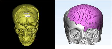 Cranial Implants - 3DIncredible