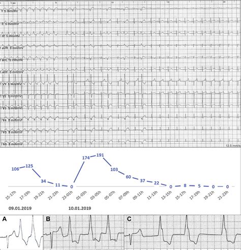 PVC Evolution after the Ablation | Download Scientific Diagram