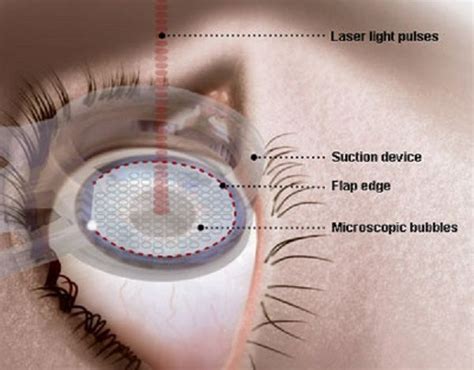 lasik eye surgery side effects lasik eye surgery side effects | Lasik ...