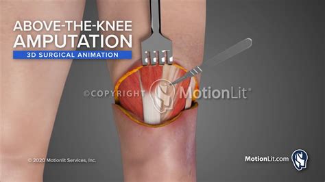 Surgical Animation Portrays Above-the-Knee Amputation - YouTube