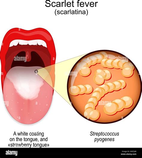 Scarlet fever. symptoms of scarlatina. Mouth with white coating on the tongue, and «strawberry ...