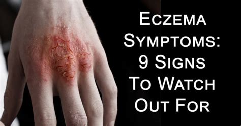 Eczema Symptoms: 9 Signs To Watch Out For - David Avocado Wolfe