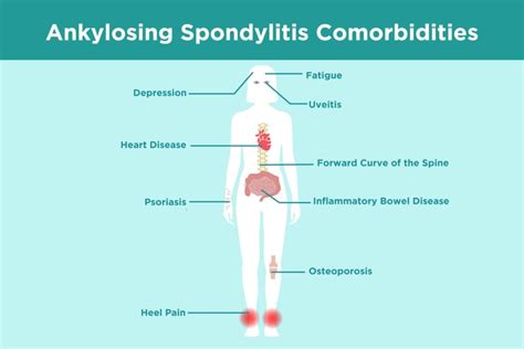 Ankylosing Spondylitis Comorbidities: What AS Patients Need to Know