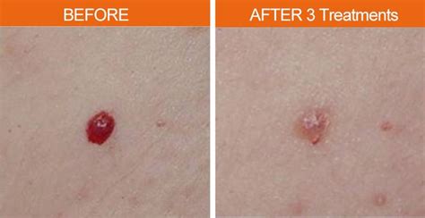 Treating Cherry Angiomas with our lasers. #Results #AestheticTechnology ...