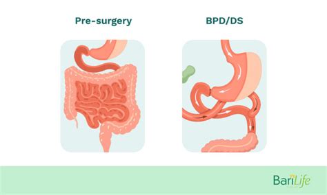 Duodenal Switch Complications - Everything you need to know