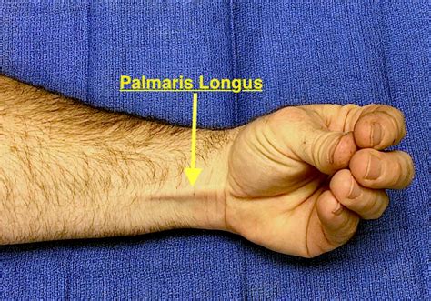 Muscle Test and Tendon Exam: Palmaris Longus | Hand Surgery Source