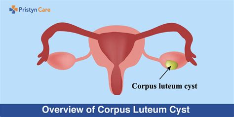 Overview of Corpus Luteum Cyst - Pristyn Care