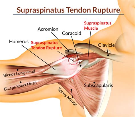 Supraspinatus Tendinitis :Cause,Sign/Symptoms,Physiotherapy Treatment