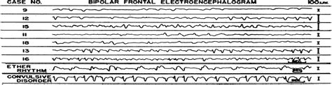 Can We Distinguish Triphasic Waves From Other Generalized Pe... : Journal of Clinical ...