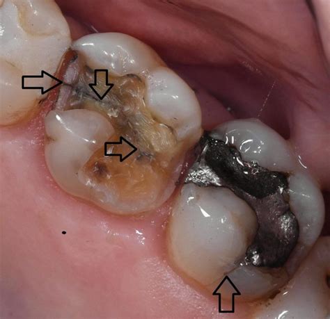 Worn, Cracked or Broken Teeth - Bega Dental Practice