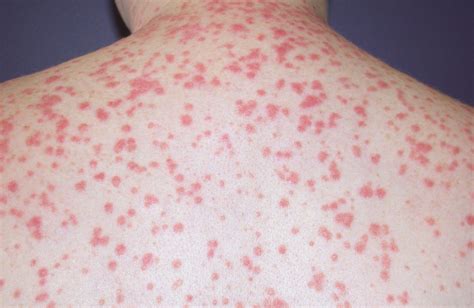 Psoriasis | Causes, Triggers, Diagnosis & Treatment