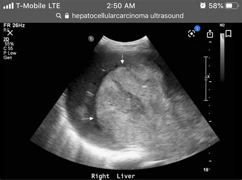 Ultrasound cases 147 of 2000 video showing lipoma right axilla and a chocolate cyst – Artofit