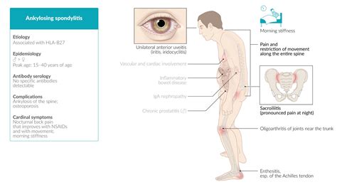 Ankylosing Spondylitis: Symptoms, Causes, Treatments, 51% OFF