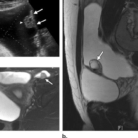 Left Iliac Fossa Pain : Acute right iliac fossa pain- the commonest ...