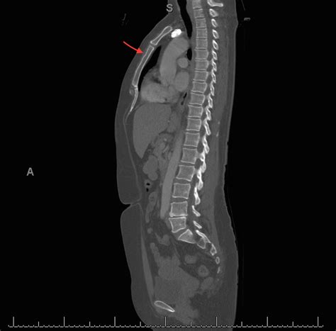 Hennepin Ultrasound | Sternal Fracture Missed on X-ray