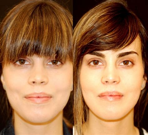 Alar Base Reduction Rhinoplasty — Lara Devgan, MD, MPH, FACS