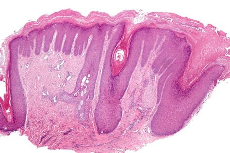 Lichen Simplex Chronicus (Neurodermatitis) — Causes and Symptoms