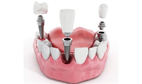 Mini Dental Implants vs. Regular: Unveiling the Differences