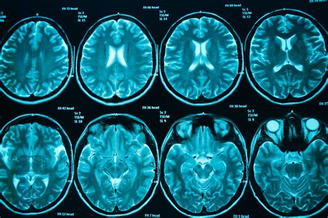 Imaging agent could reveal chronic traumatic encephalopathy in living brain - Neuro Central