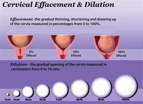 Cervix - Incompetent, Effaced, Short, Soft, and Low cervix