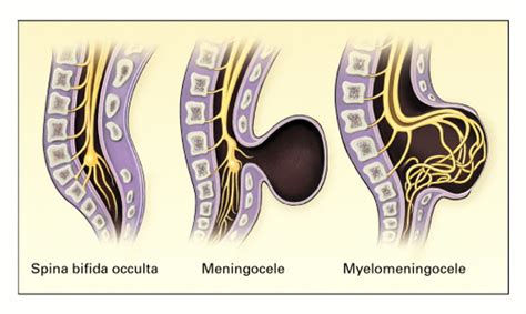 Neural Tube Defects Diagram | Quizlet