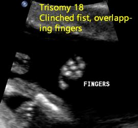 Trisomy 18 Fetal Ultrasound