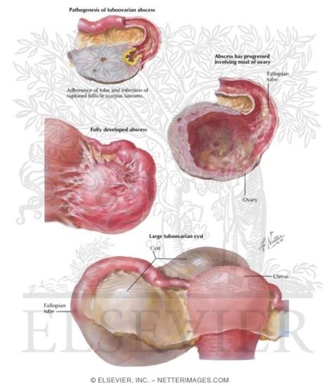 Tubo Ovarian Abscess Histology