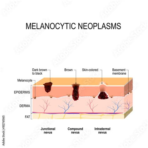 "Melanocytic nevus" Stock image and royalty-free vector files on ...