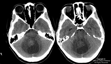 Neuroradiology On the Net: Juvenile pilocytic astrocytoma