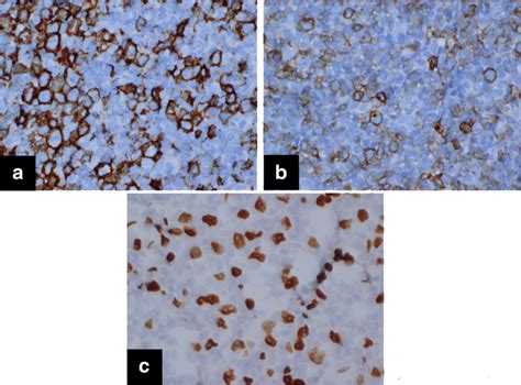 The large cells are CD20 positive (a) and CD30 positive (b) and show ...