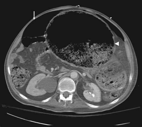 Stercoral Colitis Leading to Fatal Peritonitis: CT Findings | AJR