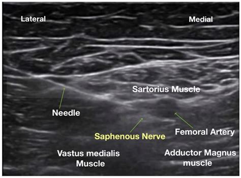 The Adductor Canal Nerve Block: A Simple and Effective Approach for Knee Pain