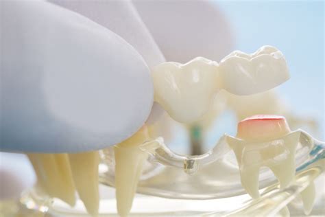 Avoiding Dental Bridge Problems | How to Take Care of Dental Bridges