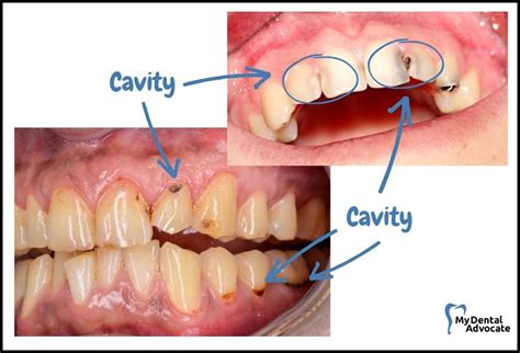 What Does a Cavity Look Like? (20 Pictures) | MDA