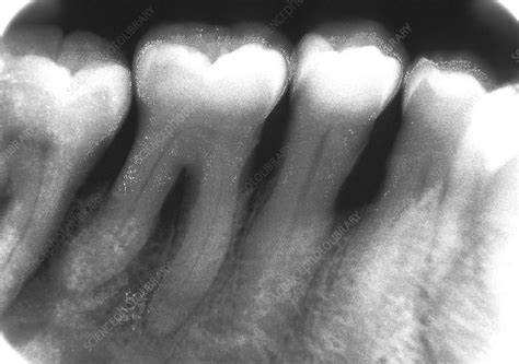 Periodontal disease, X-ray - Stock Image - C012/1381 - Science Photo Library