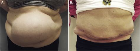 Concurrent panniculectomy in the obese ventral hernia patient: Assessment of short-term ...